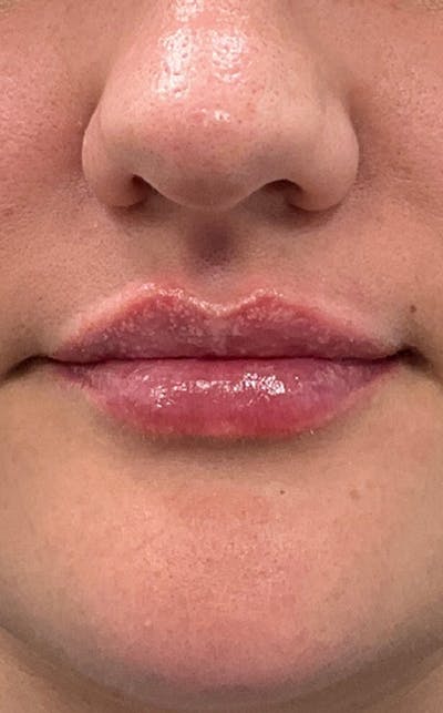 Filler Before & After Gallery - Patient 454363 - Image 2