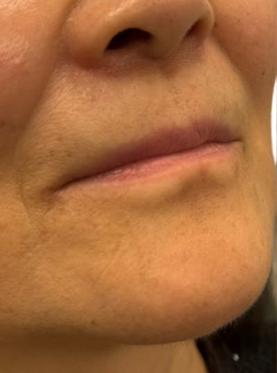 Filler Before & After Gallery - Patient 208906 - Image 1