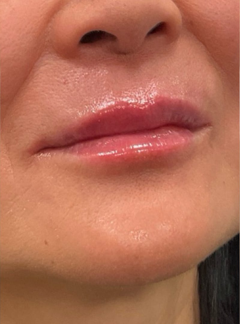 Filler Before & After Gallery - Patient 208906 - Image 2