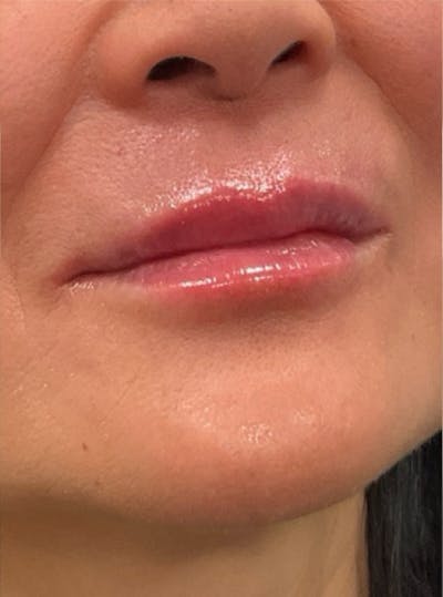 Filler Before & After Gallery - Patient 208906 - Image 2