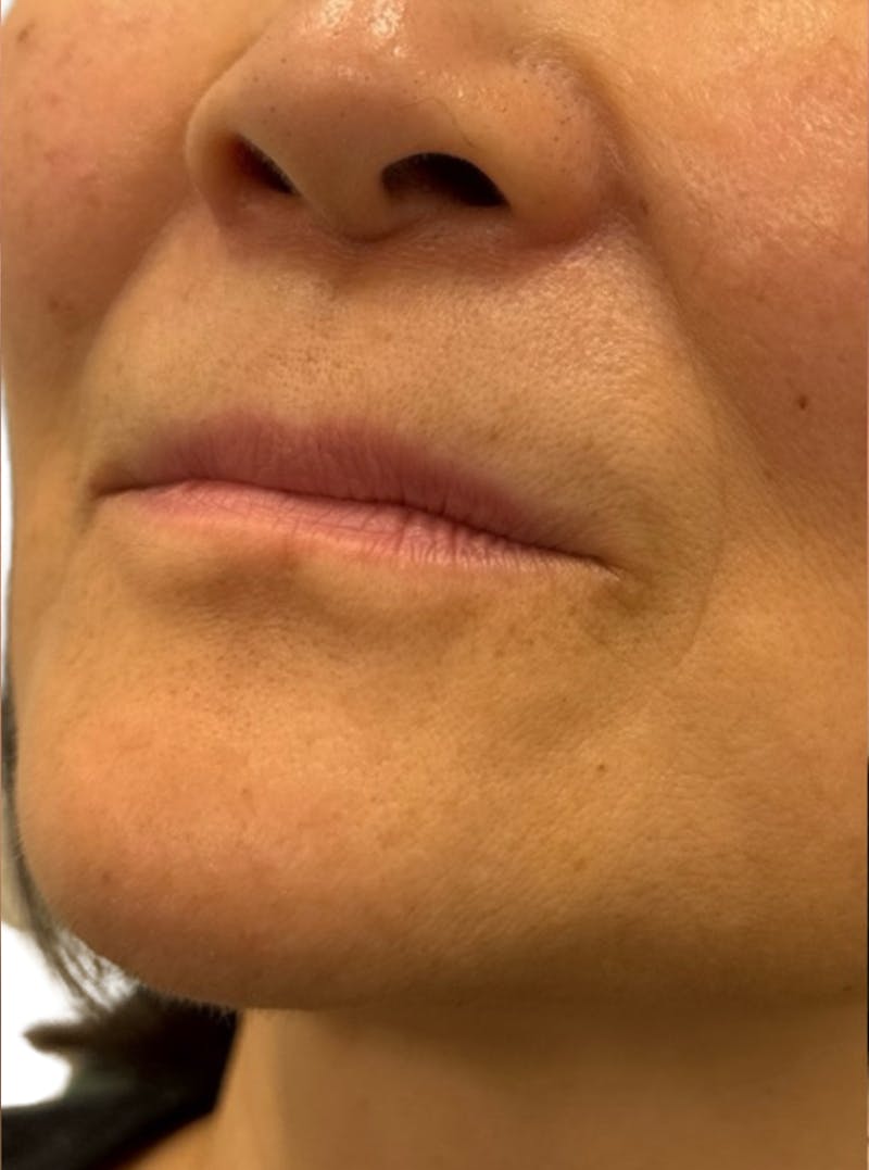 Filler Before & After Gallery - Patient 208906 - Image 3