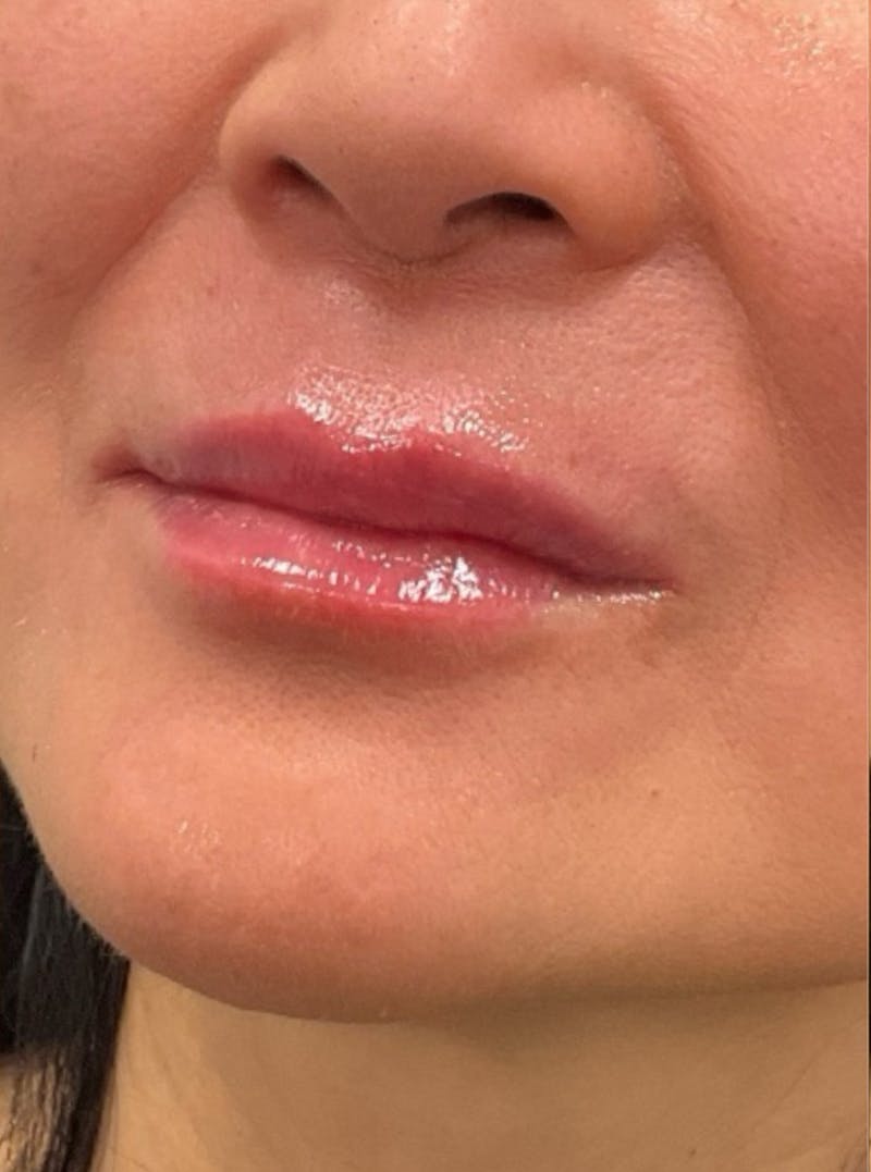 Filler Before & After Gallery - Patient 208906 - Image 4