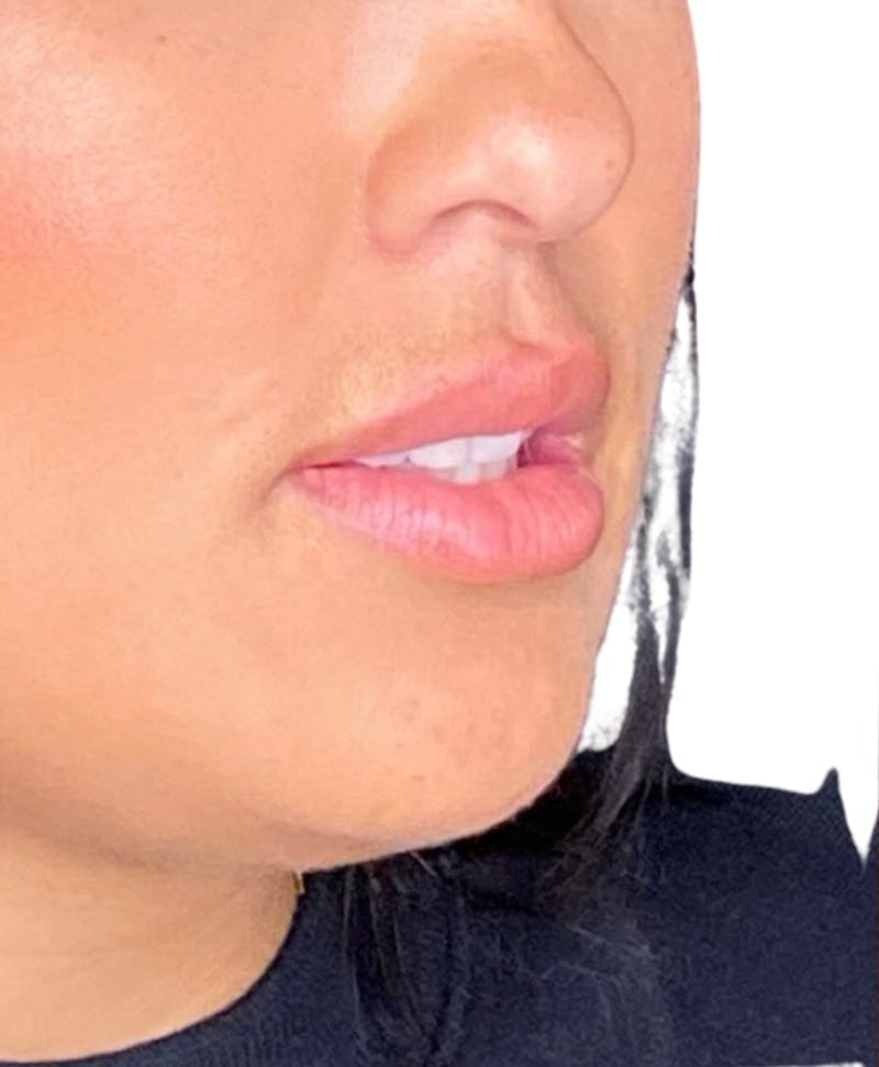 Filler Before & After Gallery - Patient 104353 - Image 1