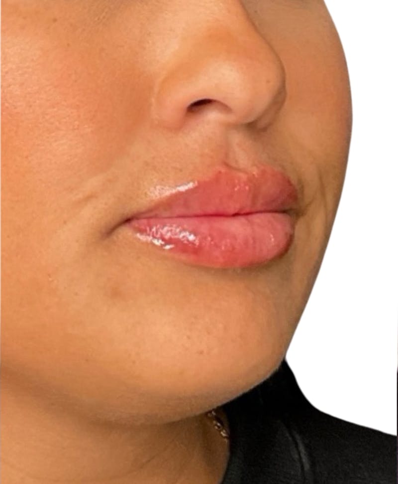 Filler Before & After Gallery - Patient 104353 - Image 2