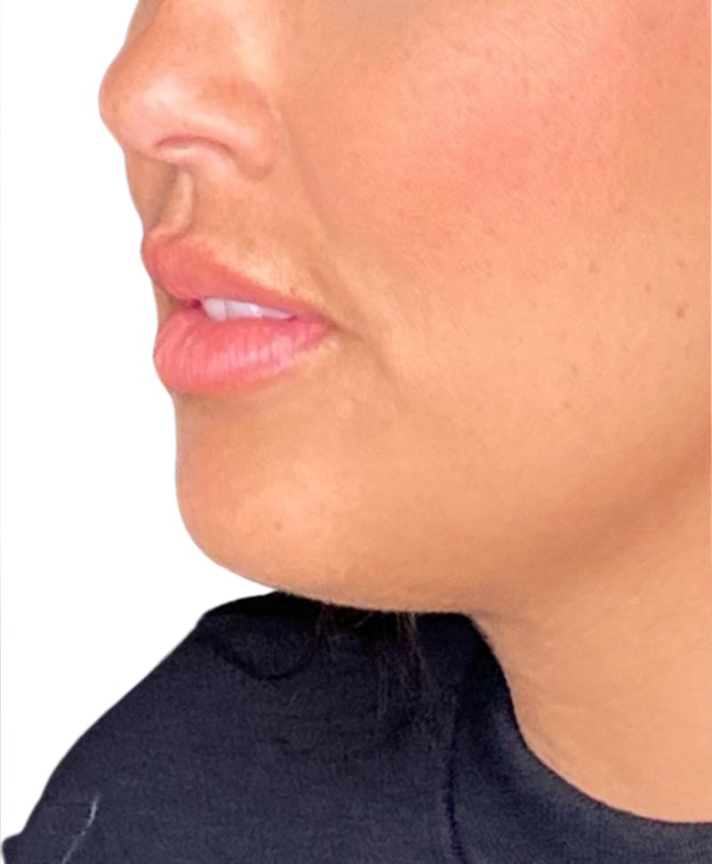 Filler Before & After Gallery - Patient 104353 - Image 3