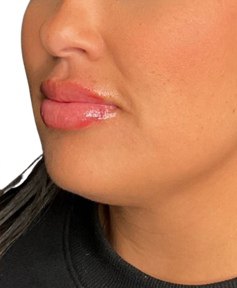 Filler Before & After Gallery - Patient 104353 - Image 4