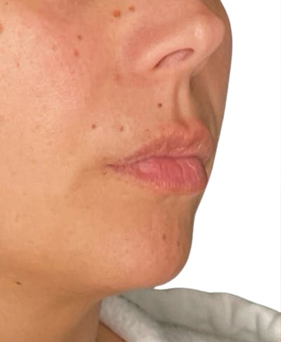 Filler Before & After Gallery - Patient 252522 - Image 1