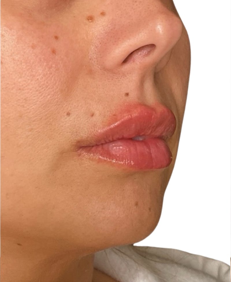Filler Before & After Gallery - Patient 252522 - Image 2