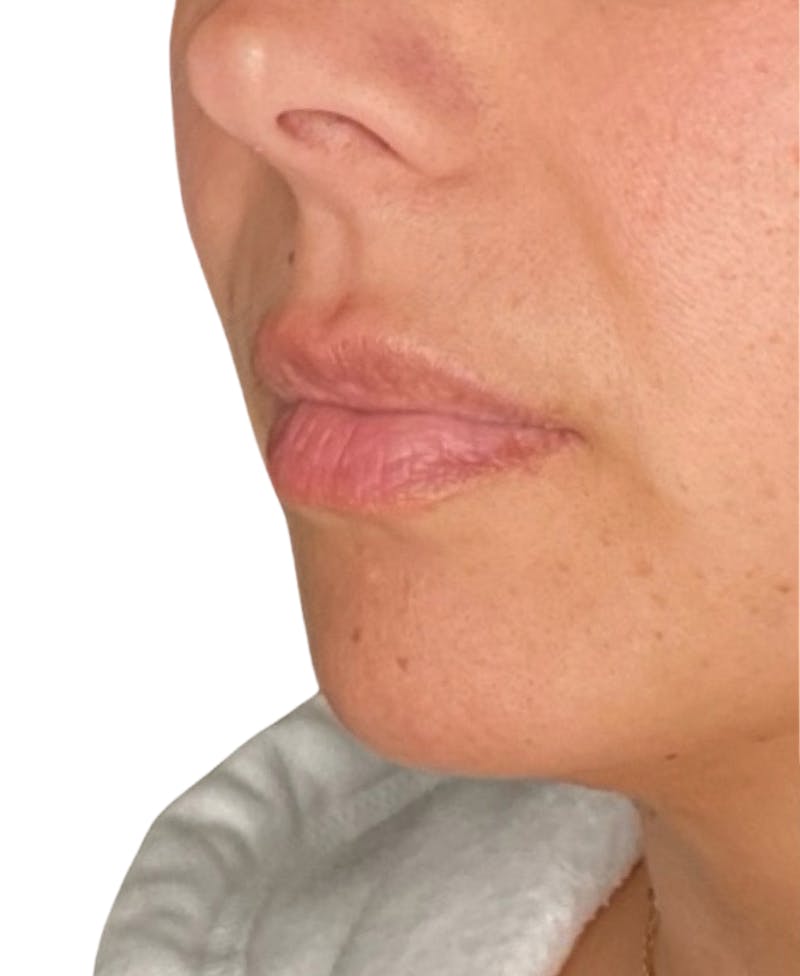 Filler Before & After Gallery - Patient 252522 - Image 3