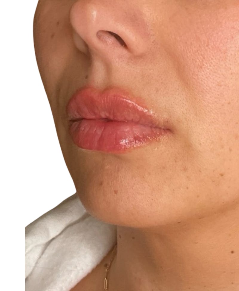 Filler Before & After Gallery - Patient 252522 - Image 4