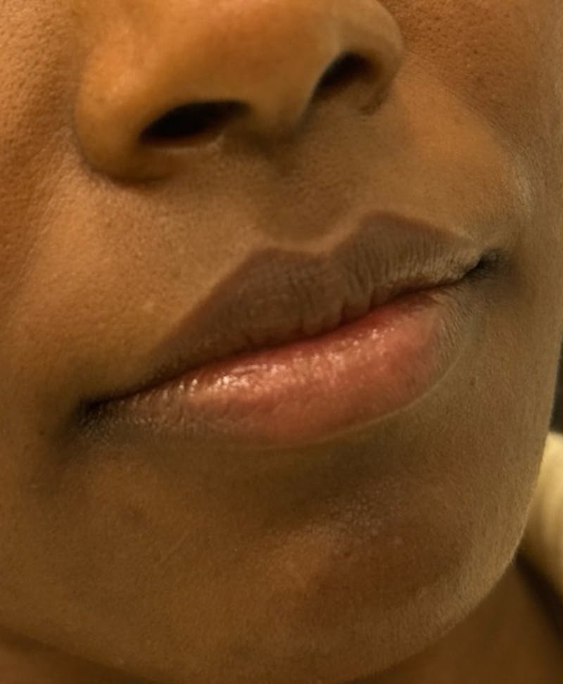 Filler Before & After Gallery - Patient 361153 - Image 1