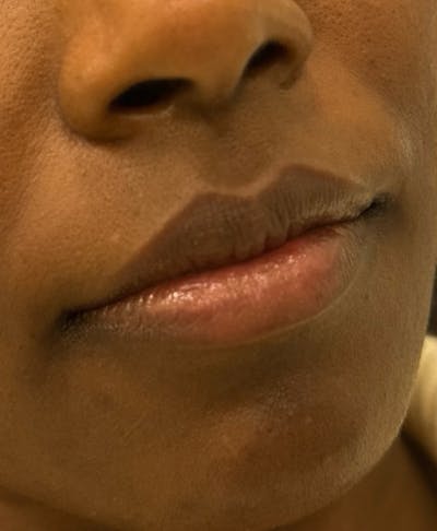 Filler Before & After Gallery - Patient 361153 - Image 1