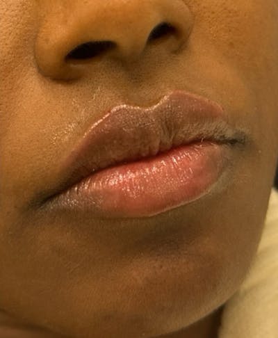 Filler Before & After Gallery - Patient 361153 - Image 2