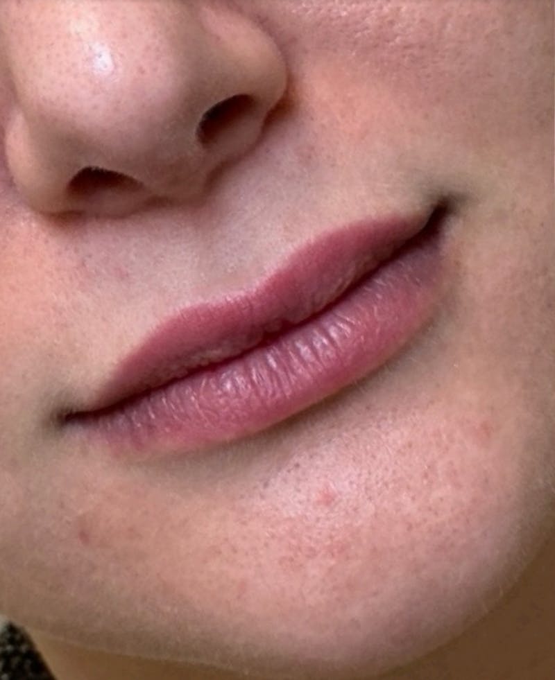 Filler Before & After Gallery - Patient 238940 - Image 1