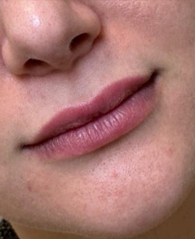 Filler Before & After Gallery - Patient 238940 - Image 1