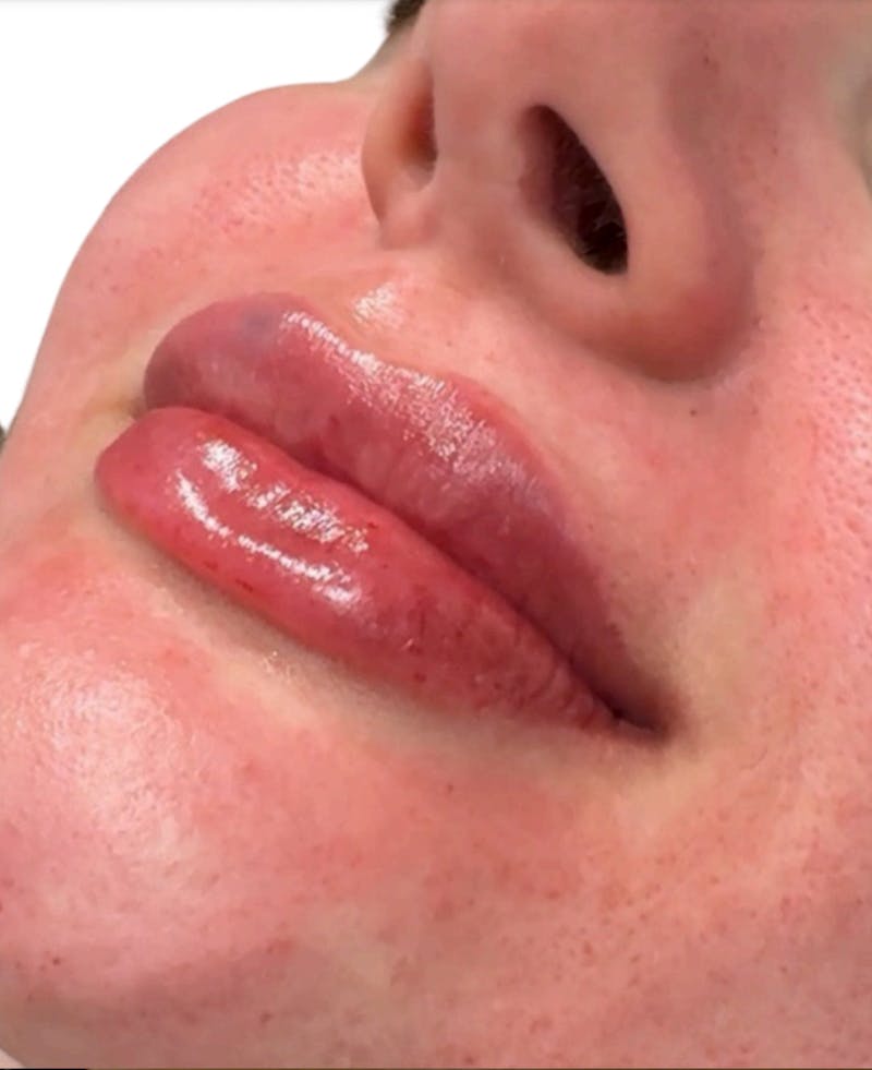 Filler Before & After Gallery - Patient 238940 - Image 2