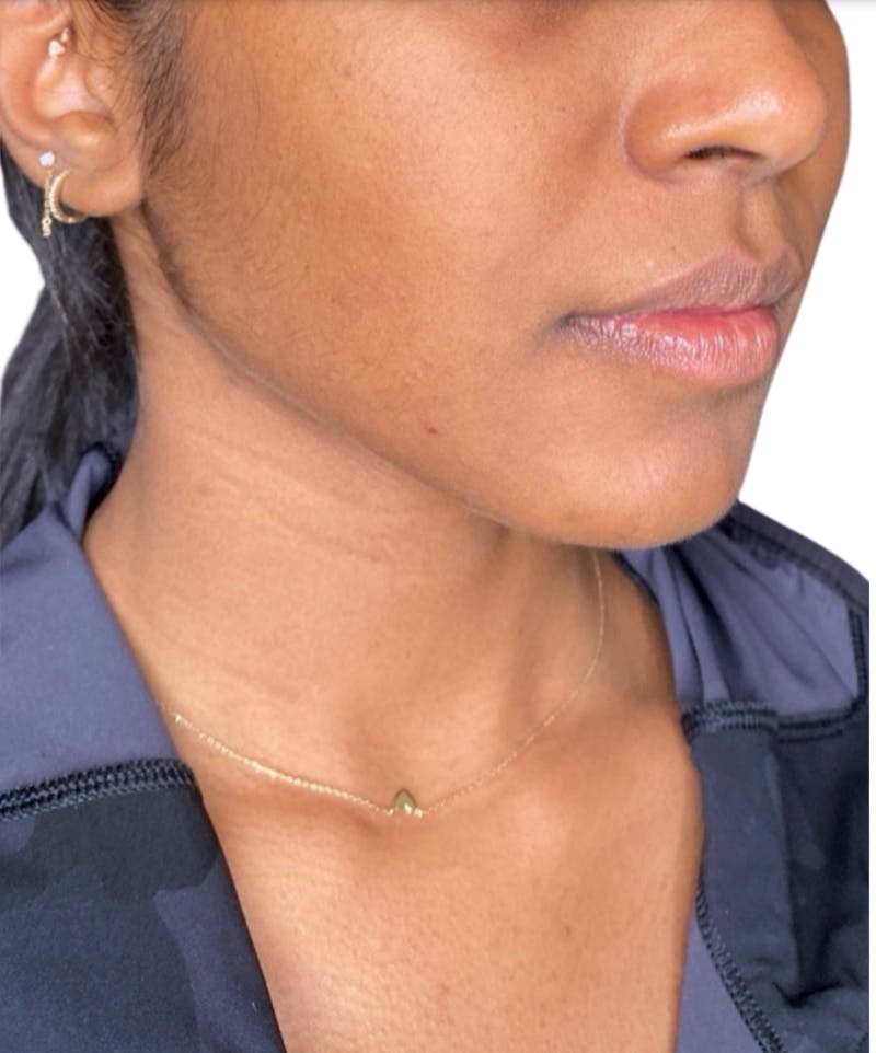 Filler Before & After Gallery - Patient 316915 - Image 2