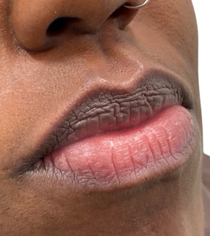 Filler Before & After Gallery - Patient 200901 - Image 1