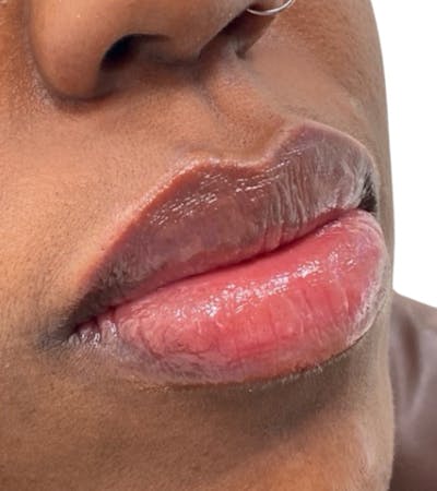 Filler Before & After Gallery - Patient 200901 - Image 2