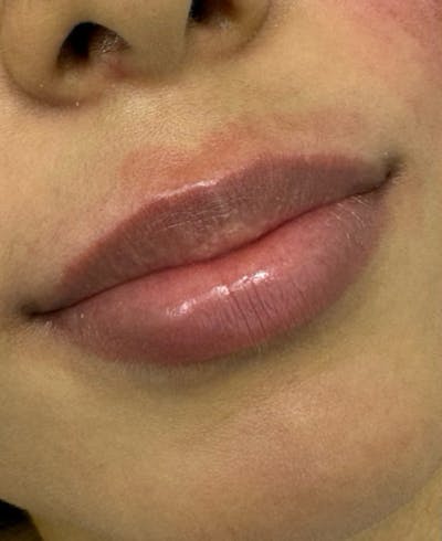 Filler Before & After Gallery - Patient 113922 - Image 1