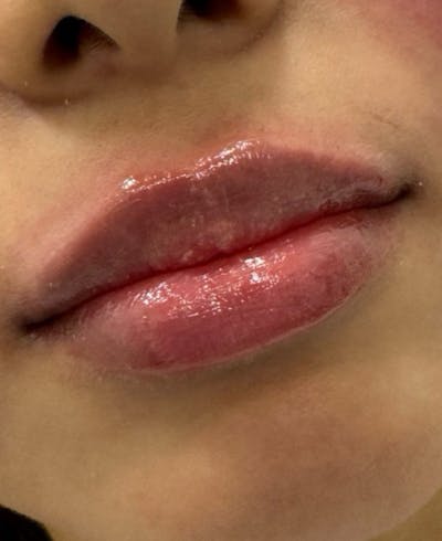 Filler Before & After Gallery - Patient 113922 - Image 2