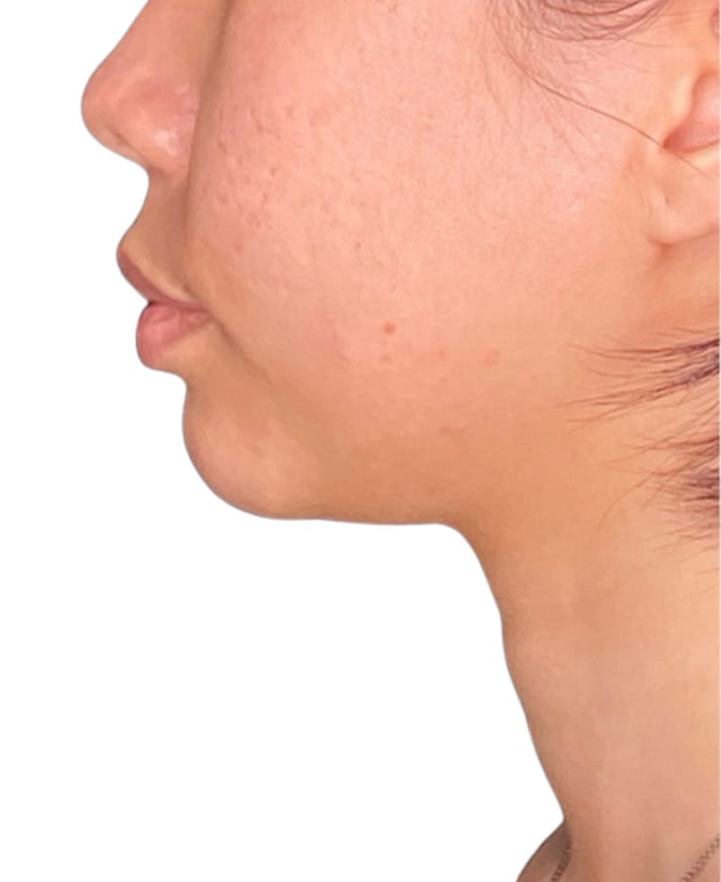 Filler Before & After Gallery - Patient 182062 - Image 1