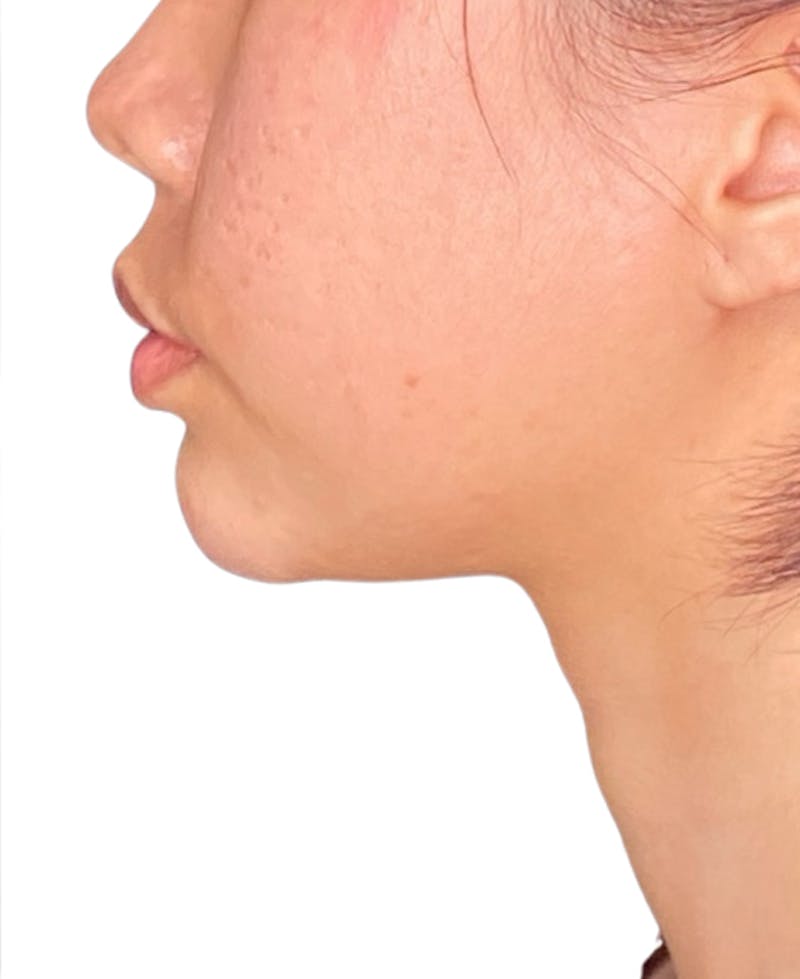 Filler Before & After Gallery - Patient 182062 - Image 2