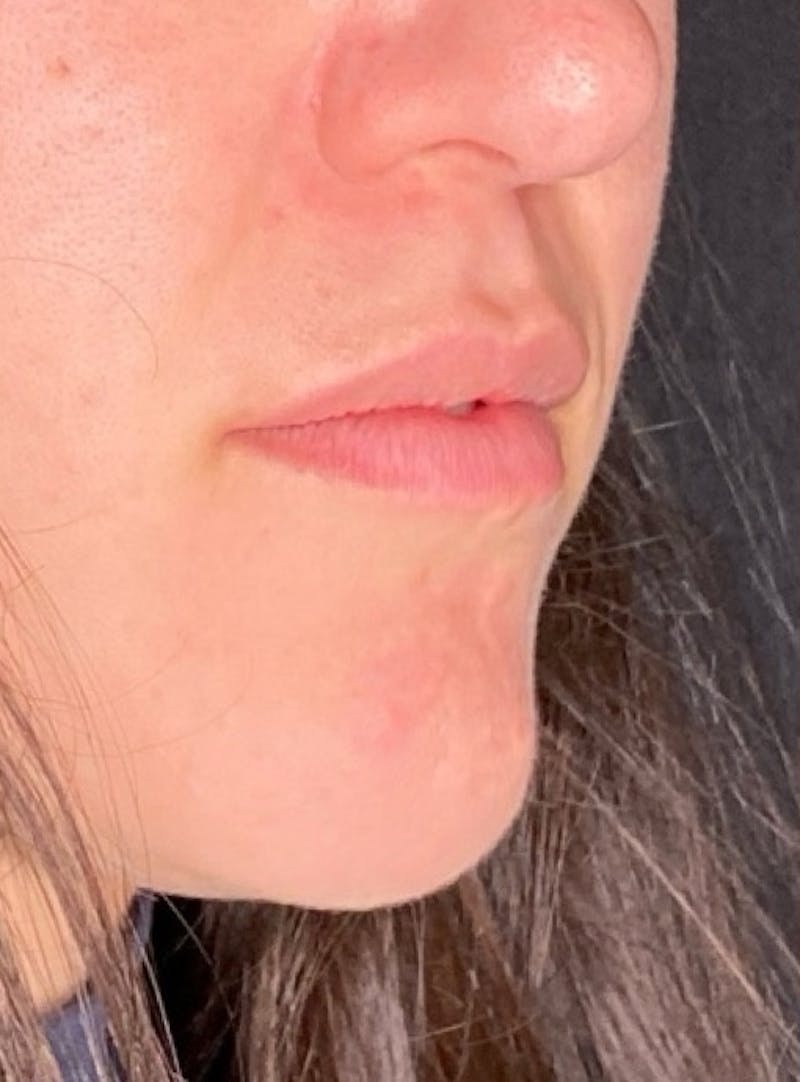 Filler Before & After Gallery - Patient 128833 - Image 1