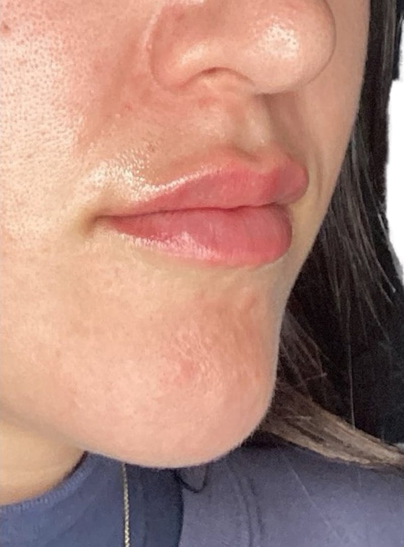 Filler Before & After Gallery - Patient 128833 - Image 2