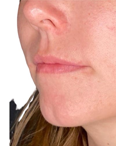 Filler Before & After Gallery - Patient 249684 - Image 1