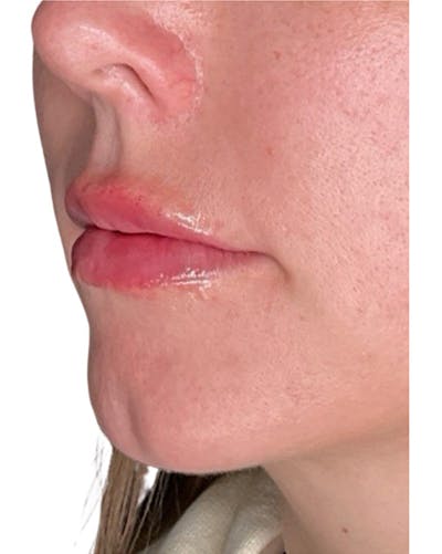 Filler Before & After Gallery - Patient 249684 - Image 2