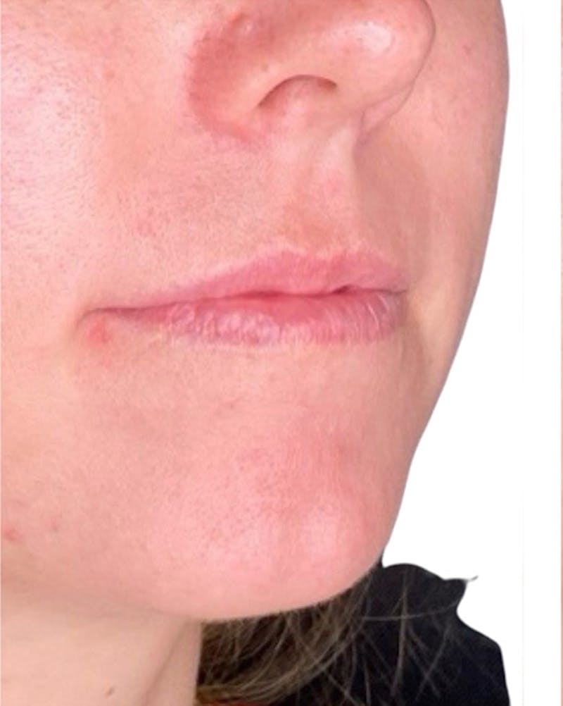 Filler Before & After Gallery - Patient 249684 - Image 3