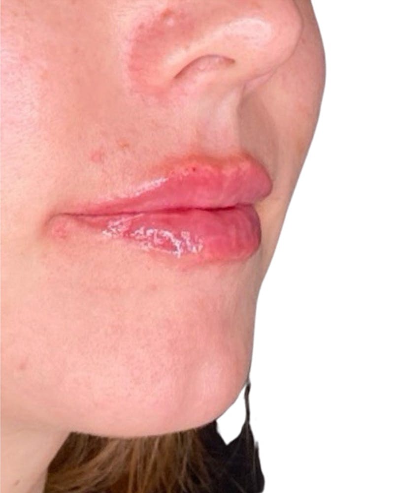 Filler Before & After Gallery - Patient 249684 - Image 4