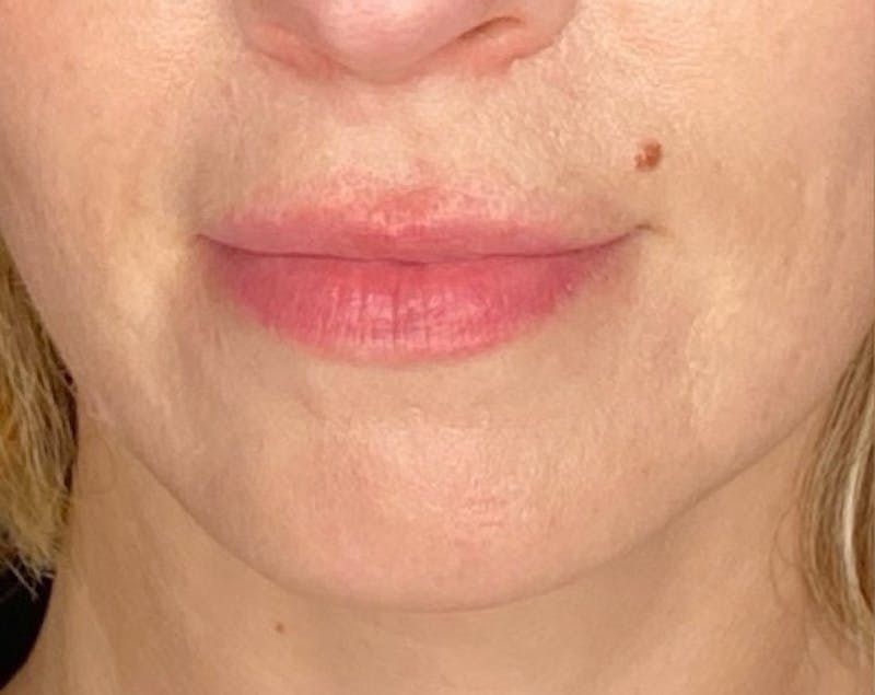 Filler Before & After Gallery - Patient 147054 - Image 1