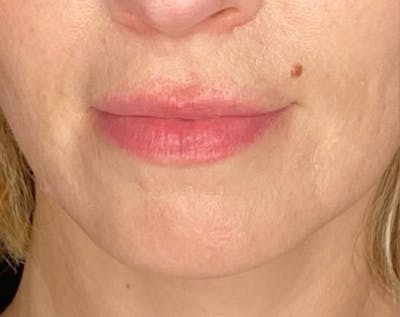 Filler Before & After Gallery - Patient 147054 - Image 1