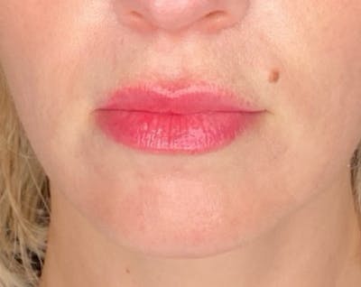 Filler Before & After Gallery - Patient 147054 - Image 2