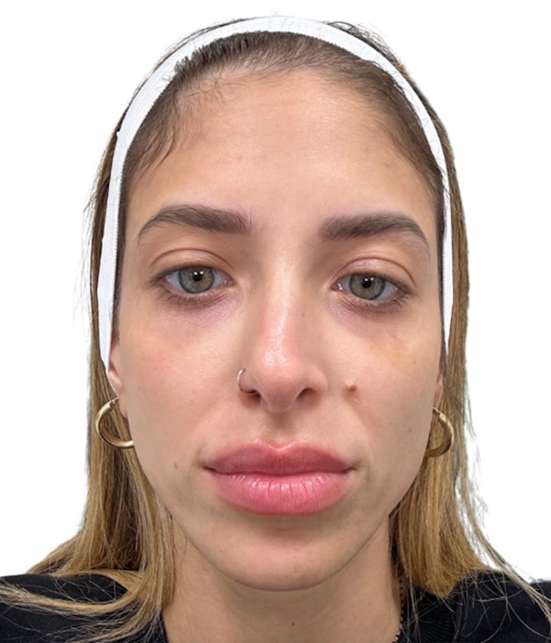 Filler Before & After Gallery - Patient 285794 - Image 1