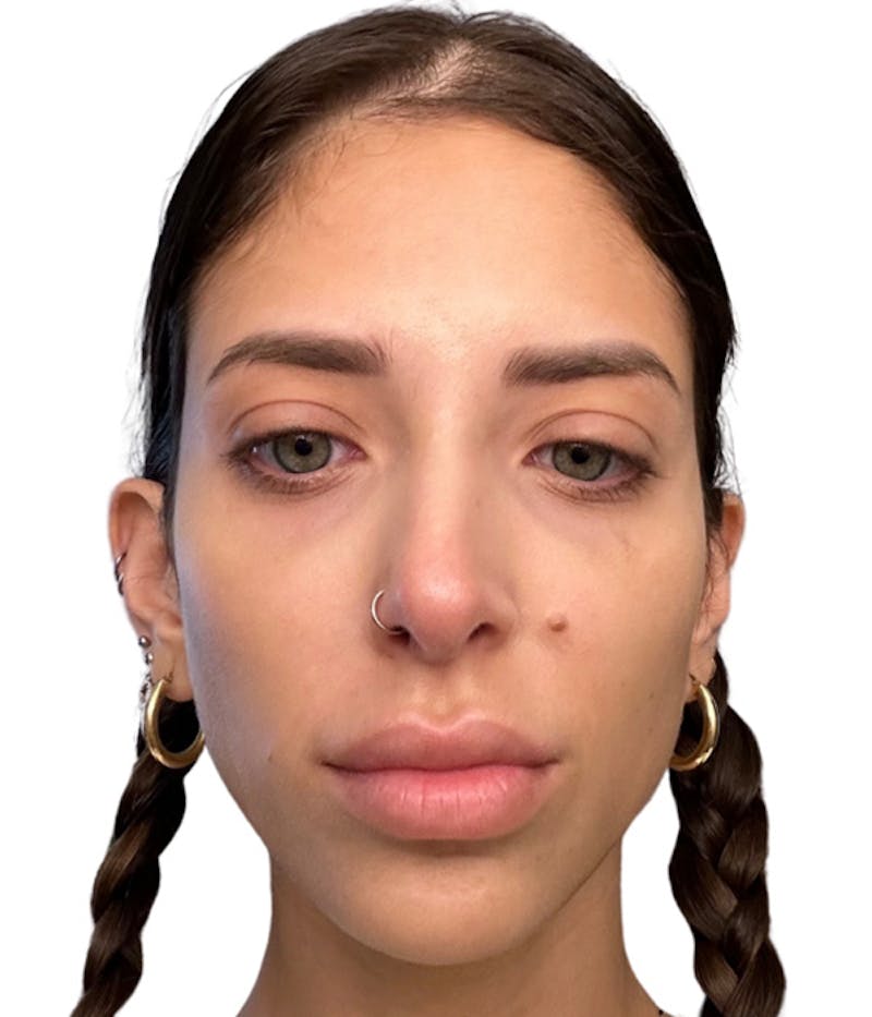 Filler Before & After Gallery - Patient 285794 - Image 2