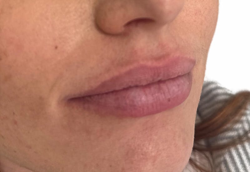 Filler Before & After Gallery - Patient 219092 - Image 1