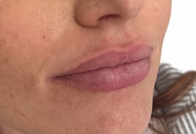 Filler Before & After Gallery - Patient 219092 - Image 1