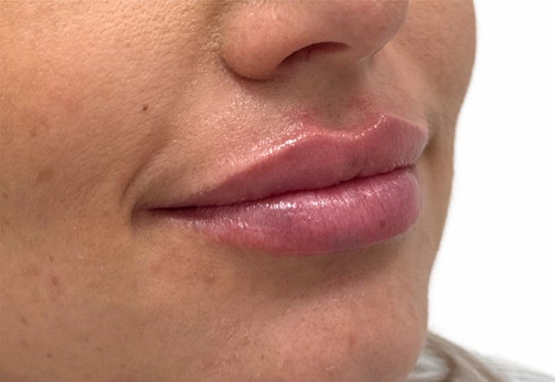 Filler Before & After Gallery - Patient 219092 - Image 2