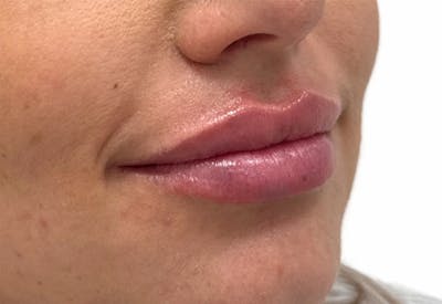 Filler Before & After Gallery - Patient 219092 - Image 2