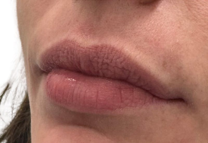 Filler Before & After Gallery - Patient 662006 - Image 1