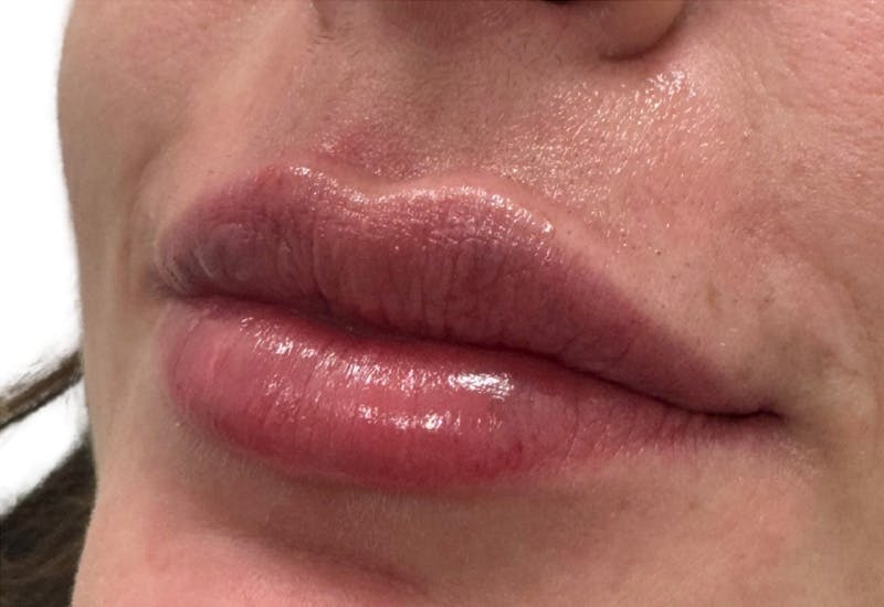 Filler Before & After Gallery - Patient 662006 - Image 2