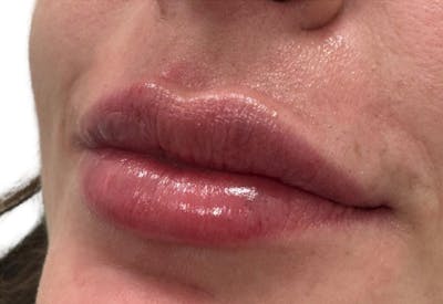 Filler Before & After Gallery - Patient 662006 - Image 2