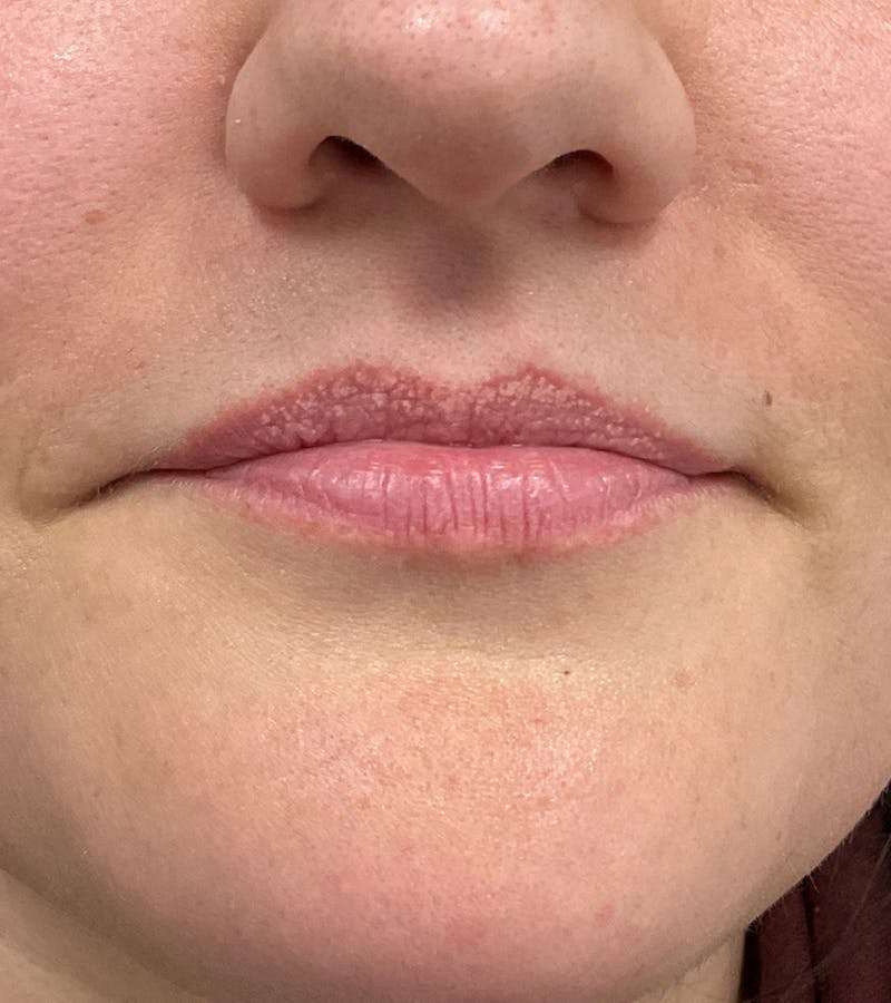 Filler Before & After Gallery - Patient 210645 - Image 1