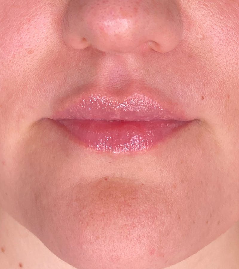 Filler Before & After Gallery - Patient 210645 - Image 2