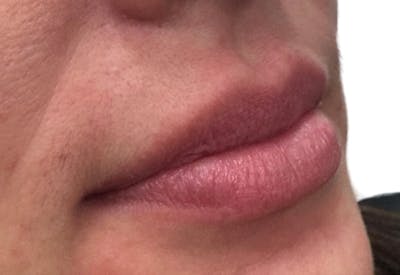 Filler Before & After Gallery - Patient 366804 - Image 1