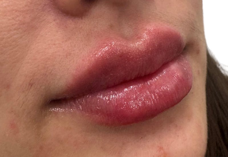 Filler Before & After Gallery - Patient 366804 - Image 2