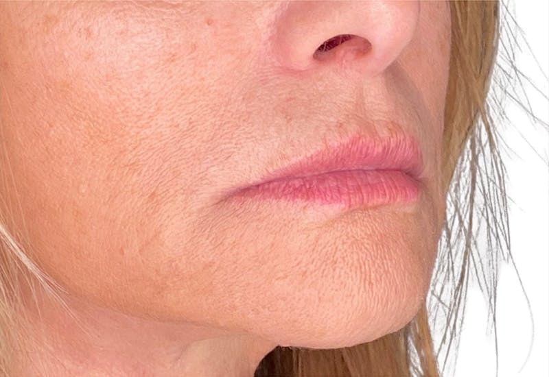 Filler Before & After Gallery - Patient 227662 - Image 1